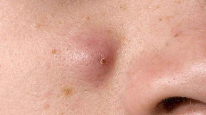 خشک شدن کورک پوستی 45645644