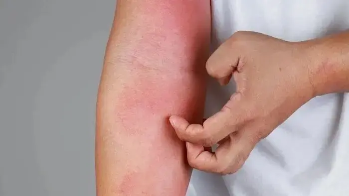 نشانه های کهیر پوستی روی صورت 565654645